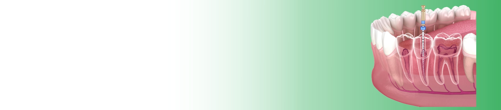 dental root canal treatment
